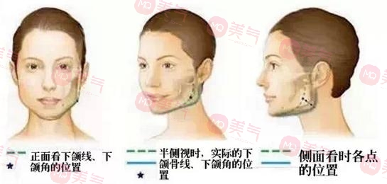 北京八大處頜面外科哪個(gè)大夫好？張智勇醫(yī)生-下頜角案例圖反饋