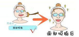 面部吸脂