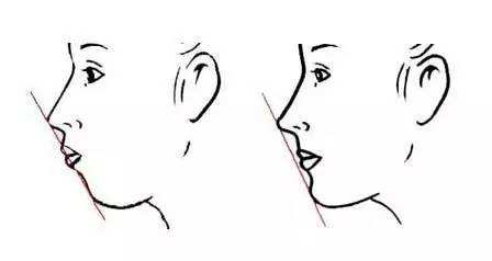凸嘴改善介紹,效果、價(jià)格和優(yōu)缺點(diǎn)是什么？