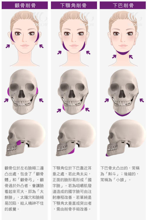 下顎前凸項(xiàng)目介紹,價(jià)格是多少？附案例展示