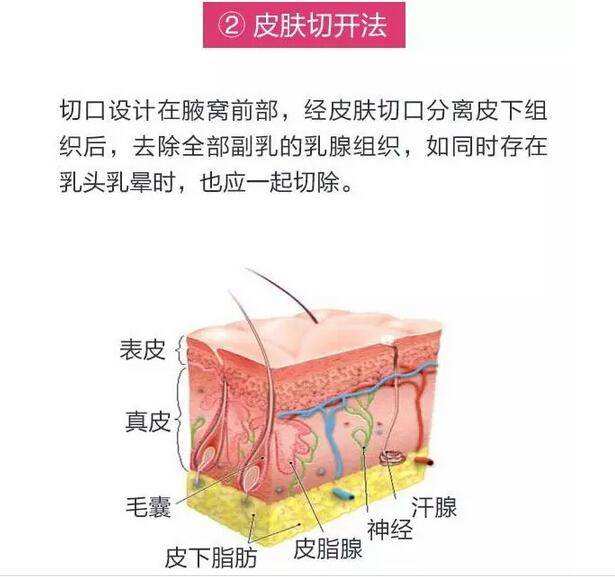 吸脂去副乳要多少錢(qián)？效果好不好？項(xiàng)目介紹和優(yōu)缺點(diǎn)盤(pán)點(diǎn)