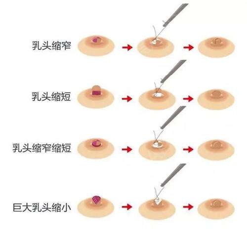 乳房縮小多少錢？效果怎么樣？簡介和優(yōu)缺點盤點