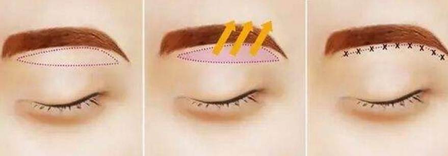 切眉術(shù)介紹,效果、價(jià)格和優(yōu)缺點(diǎn)是什么？