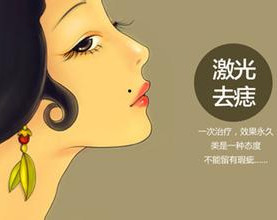 激光點痣