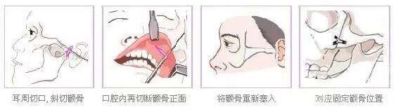 顴弓降低項(xiàng)目介紹,價(jià)格是多少？附案例展示