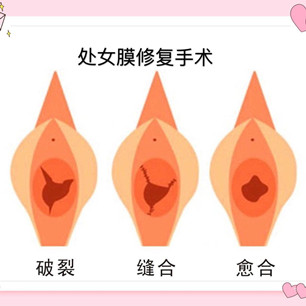 處女膜修復(fù)