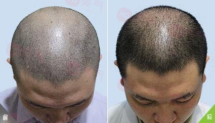 重慶毛發(fā)種植哪里有好的專業(yè)機構(gòu)嗎？