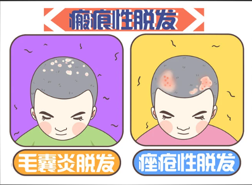廣州倍生植發(fā)醫(yī)院技術(shù)如何？選對(duì)醫(yī)院不再為禿頭煩惱！