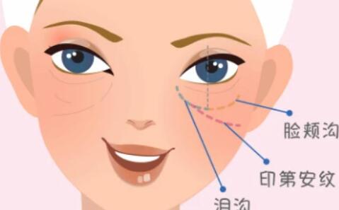 脂肪填充淚溝