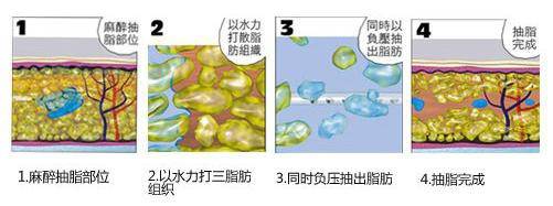 水動力吸脂減肥2.jpg