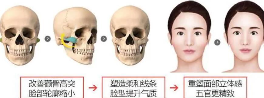 顴骨內(nèi)推動(dòng)漫4.jpg