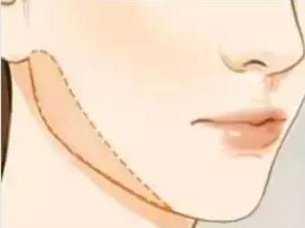下頜角動漫25.jpg