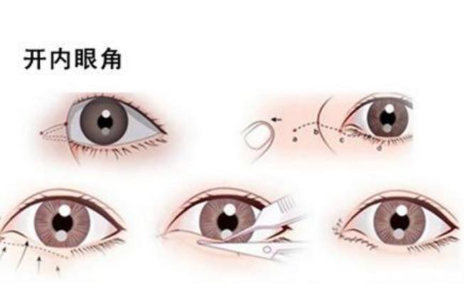 雙眼皮q03.jpg