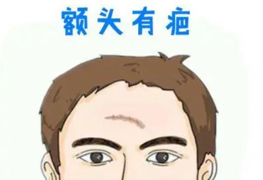 疤痕額頭dm01.jpg