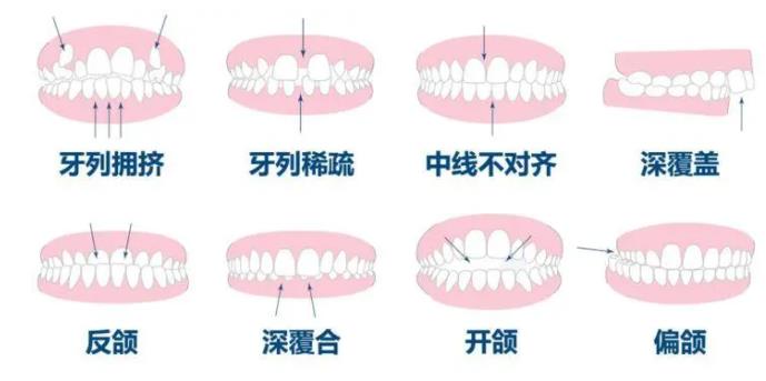 牙齒矯正hg05.jpg