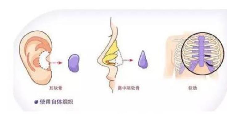 假體隆鼻.jpg