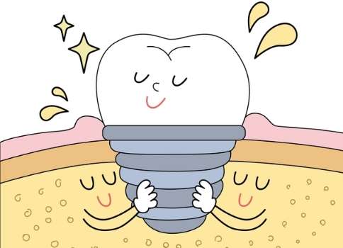 種牙植骨價格是多少？價格是在4000元到8萬元之間