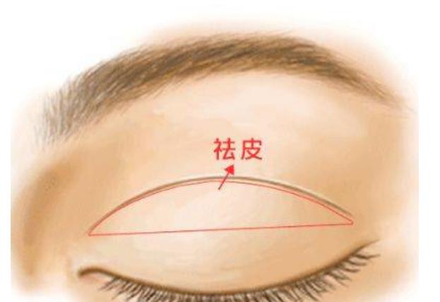 雙眼皮q1.jpg