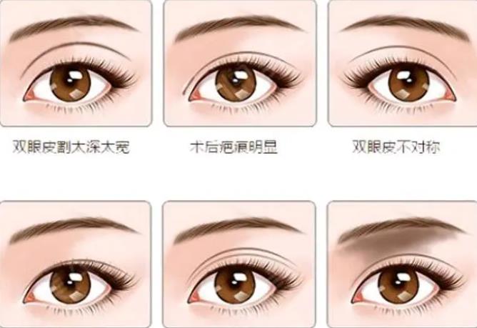 雙眼皮dm05.jpg