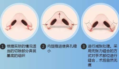 鼻翼縮小.jpg