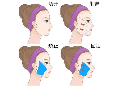 小拉皮.jpg