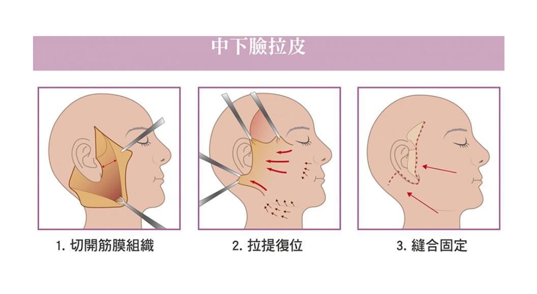 大拉皮.jpg