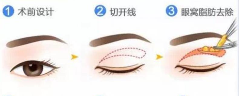雙眼皮h12.jpg