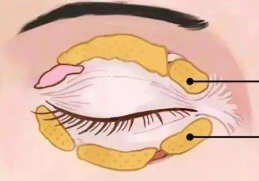 雙眼皮修復(fù)動(dòng)漫h22.jpg