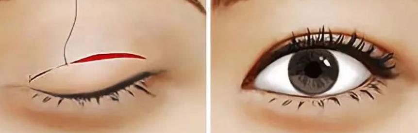 雙眼皮hg4.jpg