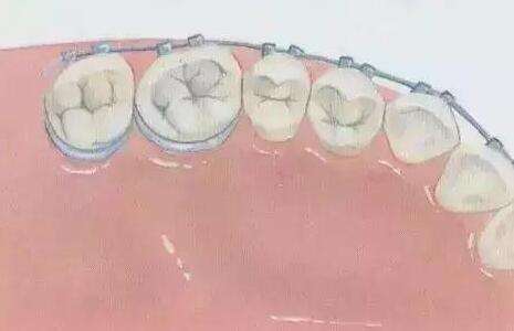 鄭大一附院牙齒矯正價格表一覽？項目費用在線分享