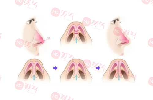 自體肋骨隆鼻的危害有哪些？手術(shù)風(fēng)險(xiǎn)、疼痛和腫脹…