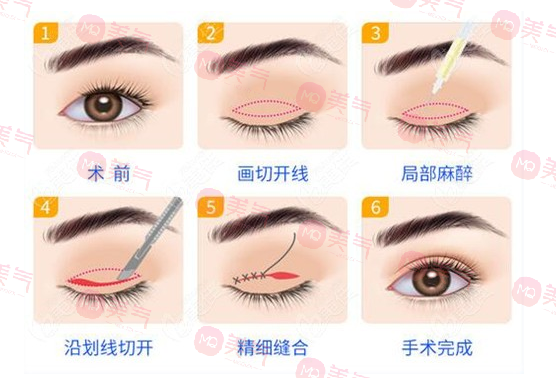 上海九院雙眼皮哪個(gè)醫(yī)生比較好？