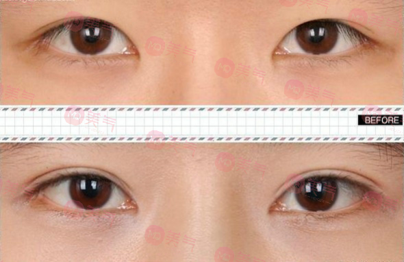 北京八大處整形雙眼皮多少錢？