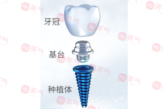 種植牙齒多少錢一顆2023？種植體品牌、醫(yī)生選擇都決定了定價！
