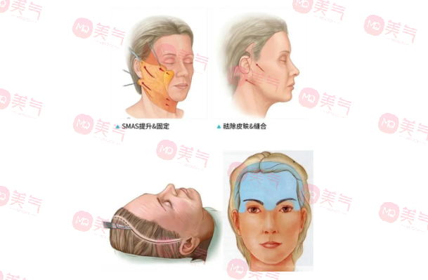 北京煤醫(yī)王馳拉皮手術(shù)多少錢？醫(yī)生技術(shù)介紹+價格表參考