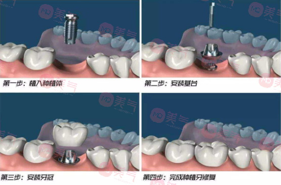 北京種植牙多少錢一顆？?jī)r(jià)格費(fèi)用_注意事項(xiàng)_使用年限