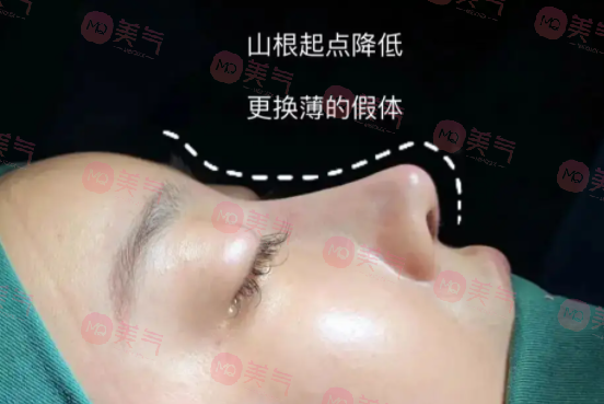 南京醫(yī)科大學友誼做鼻修復的費用多少錢