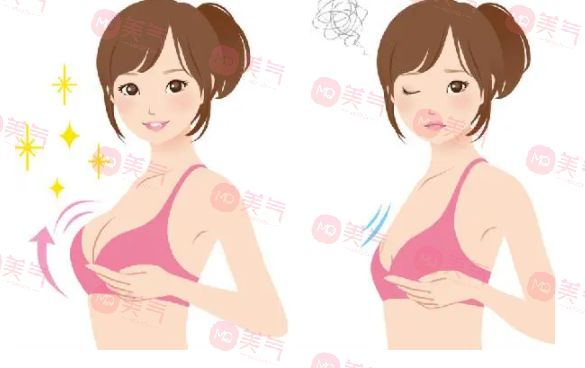 重慶豐胸得多錢？2萬的曼托假體隆胸要不要做
