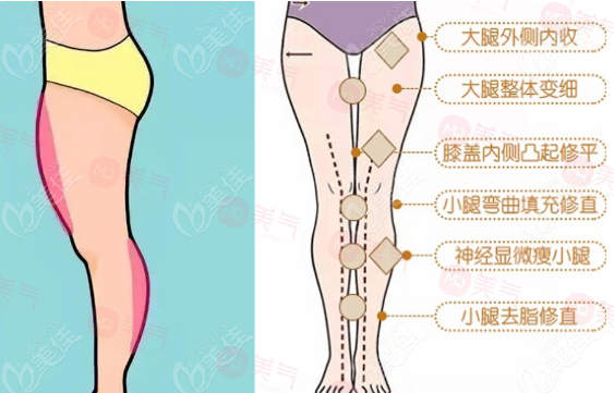 臀部吸脂手術(shù)優(yōu)點(diǎn)、作用、注意事項(xiàng)介紹