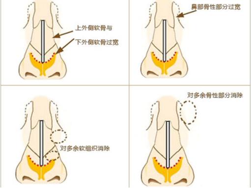 鼻骨整形