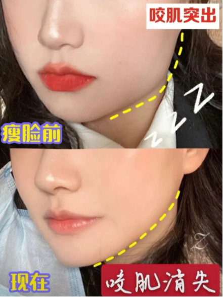 瘦臉