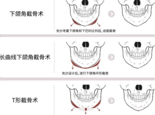 下頜角整形