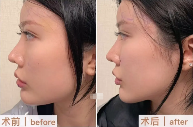 豐蘋(píng)果肌