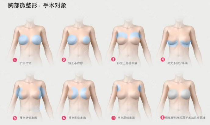 胸部整形