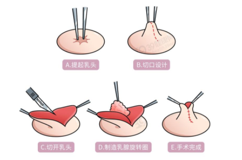 乳頭整形