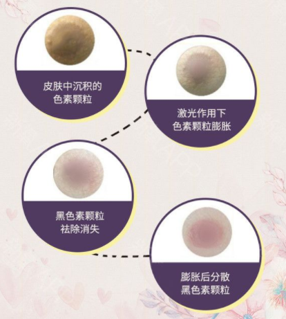 乳暈整形