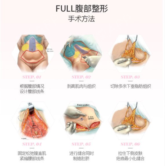 腹部整形