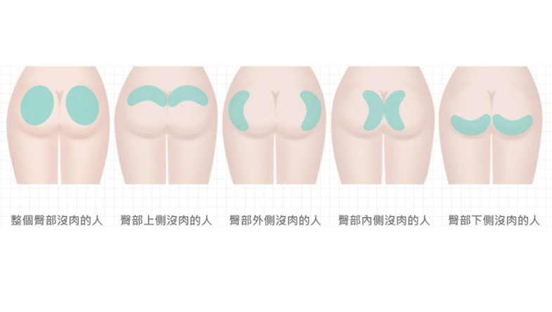 臀部塑形