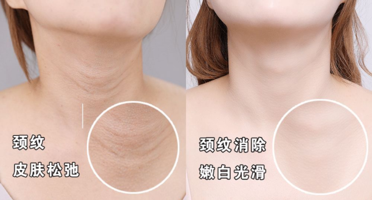 去頸紋