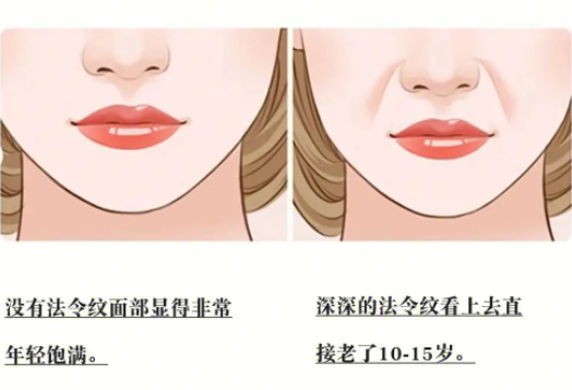 去法令紋